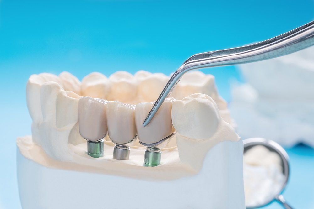 implantes dentales estratégicos