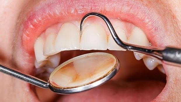 Factores de riesgo que pueden provocar la periodontitis