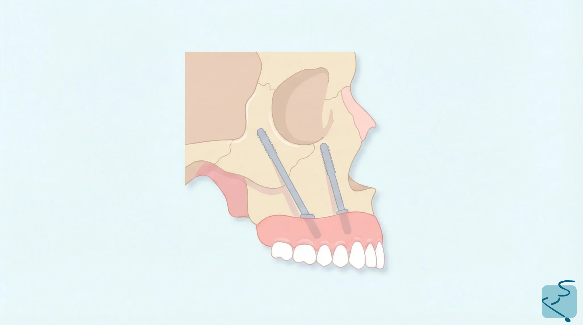 Implantes cigomáticos Sevilla